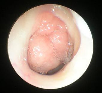  1x 1x80 adenoid9