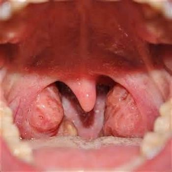  1x 1x80 chronic tonsillitis