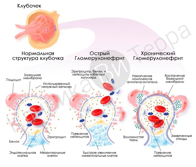 Переохлаждение организма картинки