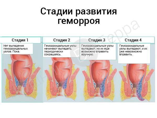 стадии геморроя фото