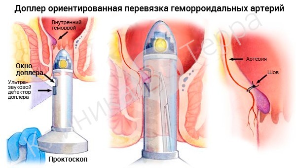 Лигирование латексными кольцами