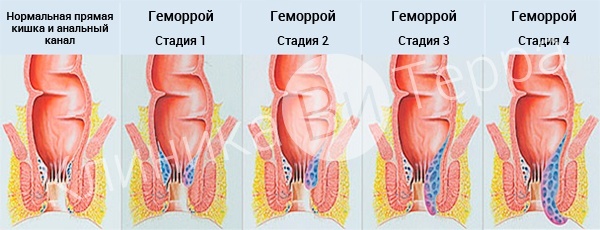 010---геморрой.jpg