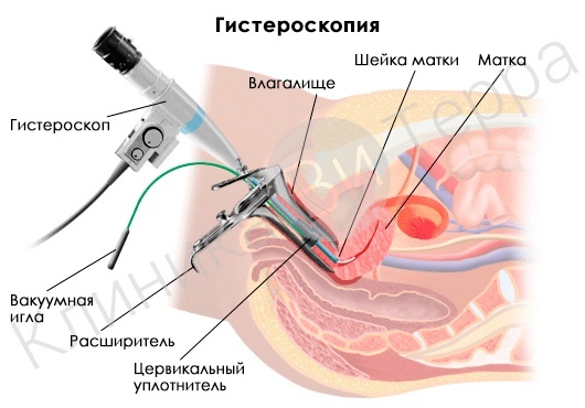 Гистероскопия фото