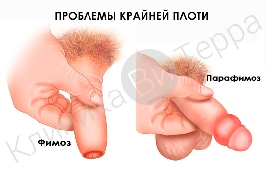 Фимоз, парафимоз