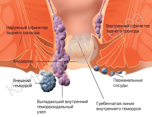 Геморрой. Внетренний геморрой. Внешний геморрой. Выпадающий узел геморроидального узла