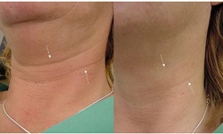 1405506937 morschiny na dekolte