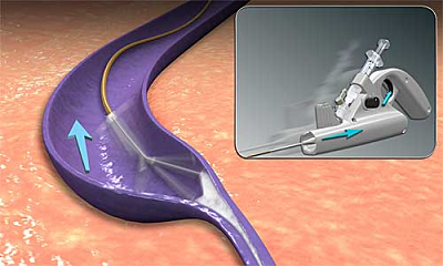 ClariVein_1.png