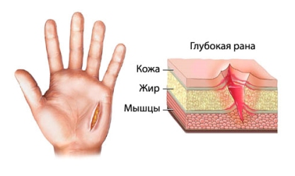 Shema glubokoj rublennoj rany