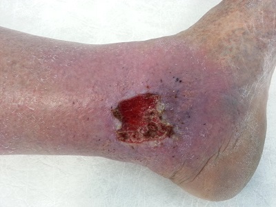 Лечение трофических язв на ногах операция thumbnail