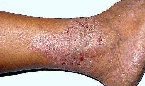 eczema
