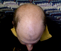 alopeciya1