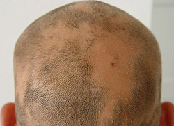 alopeciya2