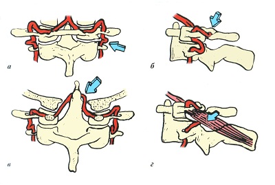 Позвоночная артерия снабжает кровью что