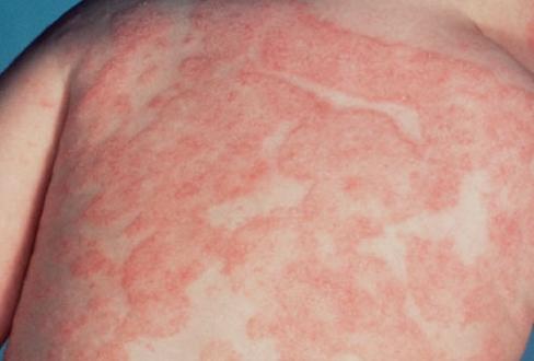 Атопический дерматит