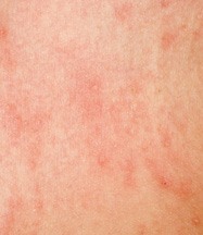 Атопический дерматит