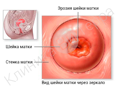 у нерожавшей женщины шейка матки какой формы. shaika matki cancer. у нерожавшей женщины шейка матки какой формы фото. у нерожавшей женщины шейка матки какой формы-shaika matki cancer. картинка у нерожавшей женщины шейка матки какой формы. картинка shaika matki cancer