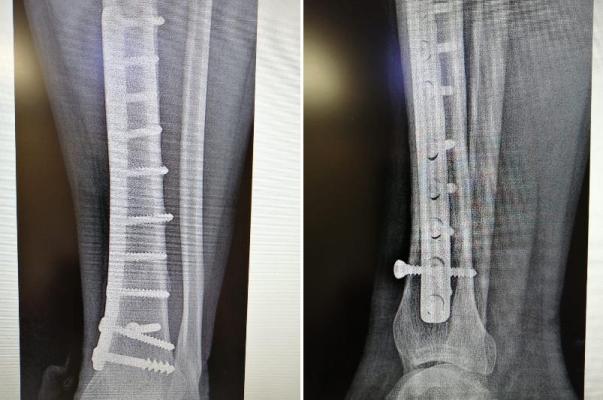 Пластина в ноге. Снятия пластины берцовой. Шов после перелома голени. Рентген после снятия пластин. Удалять пластину после остеосинтеза.