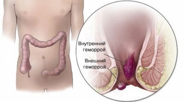 визит к проктологу истории. hemmor 2. визит к проктологу истории фото. визит к проктологу истории-hemmor 2. картинка визит к проктологу истории. картинка hemmor 2. «Случайно сел и теперь — вот. », — так 30-летний мужчина объяснил врачам присутствие овощной культуры в прямой кишке. Но колопроктологов больше интересовали не фантастические соображения пациента, а как извлечь неожиданную находку. визит к проктологу истории. hemmor 2. визит к проктологу истории фото. визит к проктологу истории-hemmor 2. картинка визит к проктологу истории. картинка hemmor 2. «Случайно сел и теперь — вот. », — так 30-летний мужчина объяснил врачам присутствие овощной культуры в прямой кишке. Но колопроктологов больше интересовали не фантастические соображения пациента, а как извлечь неожиданную находку.