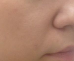 Коррекция носогубных складок до контурной пластики