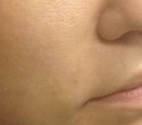 Коррекция носогубных складок после контурной пластики