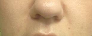 Коррекция носогубных складок после контурной пластики
