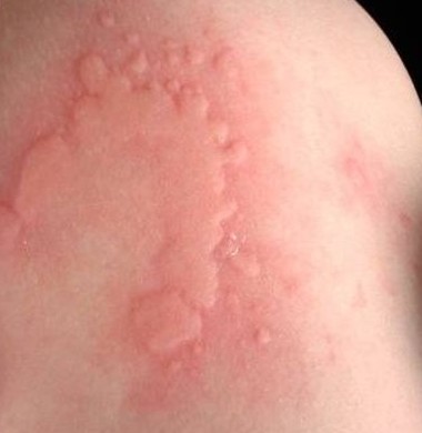 allergi insect 1