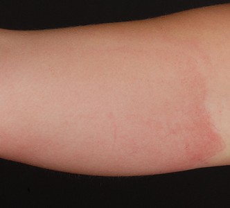 allergi insect 2