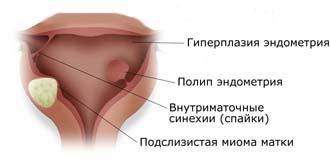 Полип полости матки