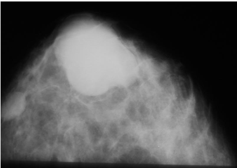 Фиброма в груди. Листовидная фиброаденома молочной железы рентген. Бугристая фиброаденома.