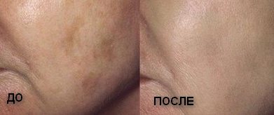 ustranenie pigmentacii