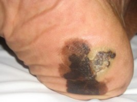 lentiginoznaya melanoma