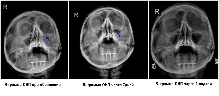 Полисинусит что это такое. Острый Гнойный полисинусит операция. Острый рецидивирующий Гнойный полисинусит.