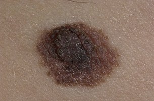 nevus atipicheskii