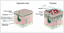 какие капельницы назначают при псориазе. Смотреть фото какие капельницы назначают при псориазе. Смотреть картинку какие капельницы назначают при псориазе. Картинка про какие капельницы назначают при псориазе. Фото какие капельницы назначают при псориазе