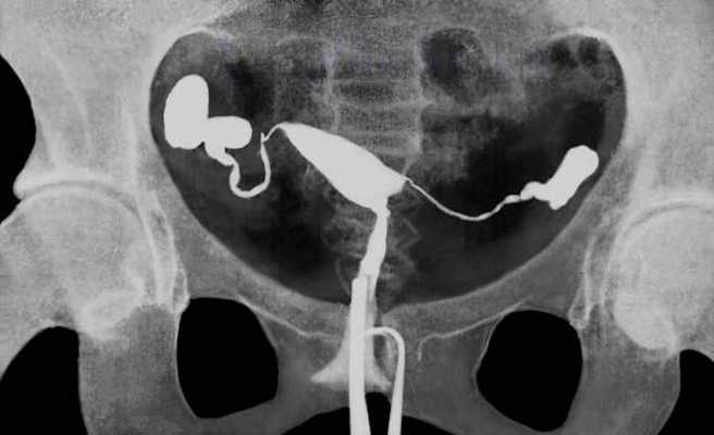 rentgen matochnyh trub