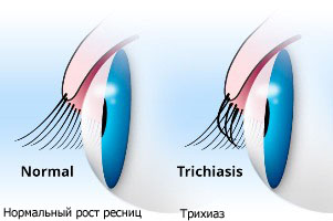 trichiasis
