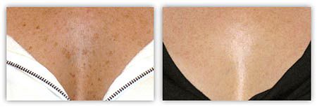 пигментация до и после