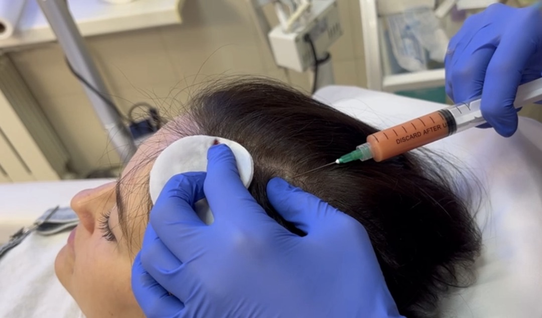 Инъекции SVF в кожу головы