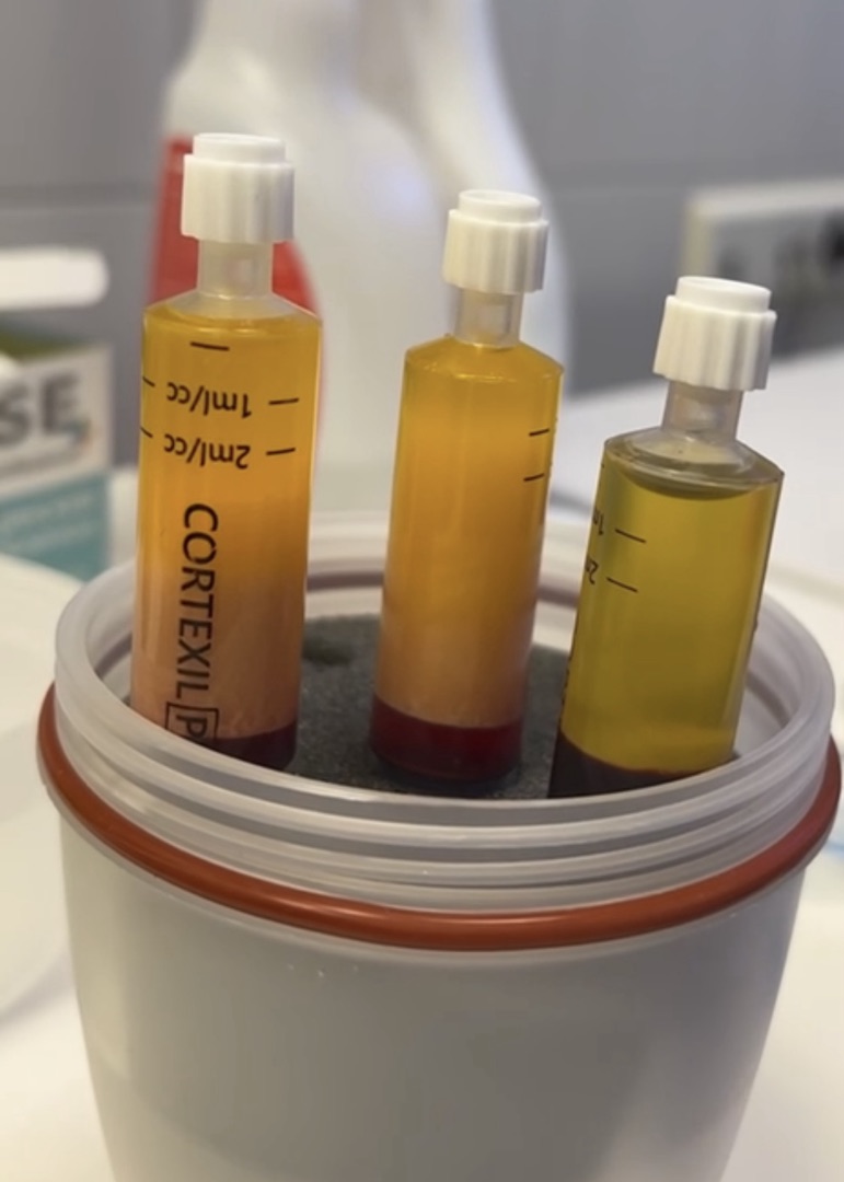 Липоаспирация перед SVF