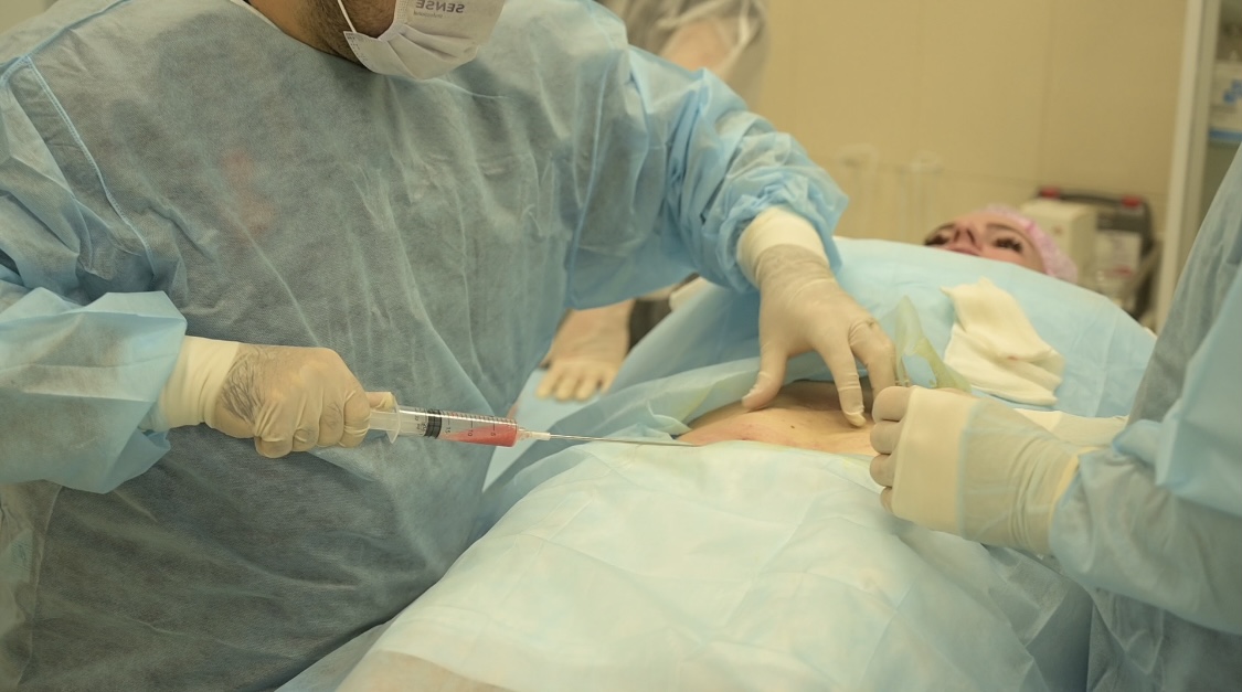 SVF процедура 1