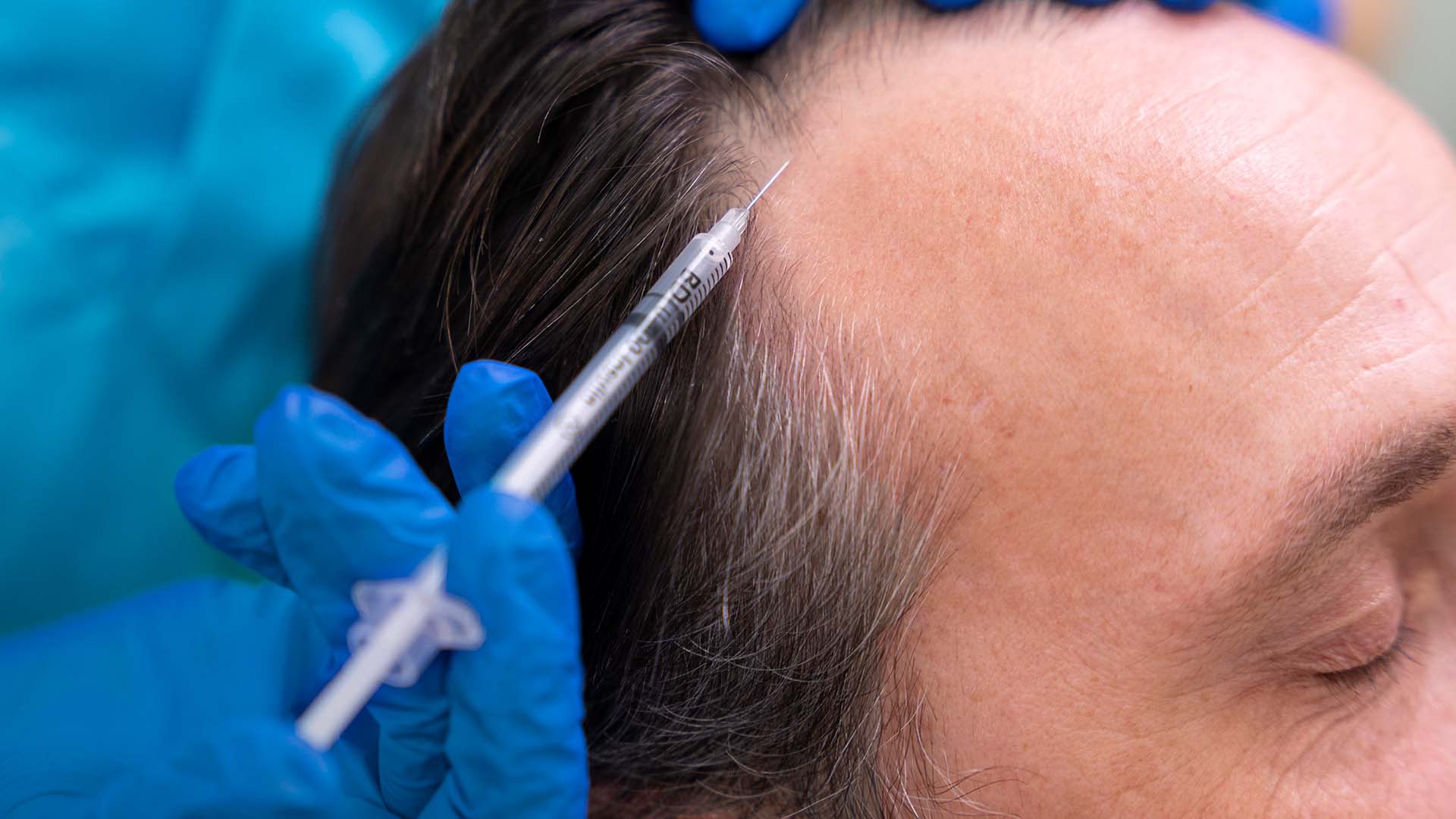 Мезотерапия кожи головы у мужчины