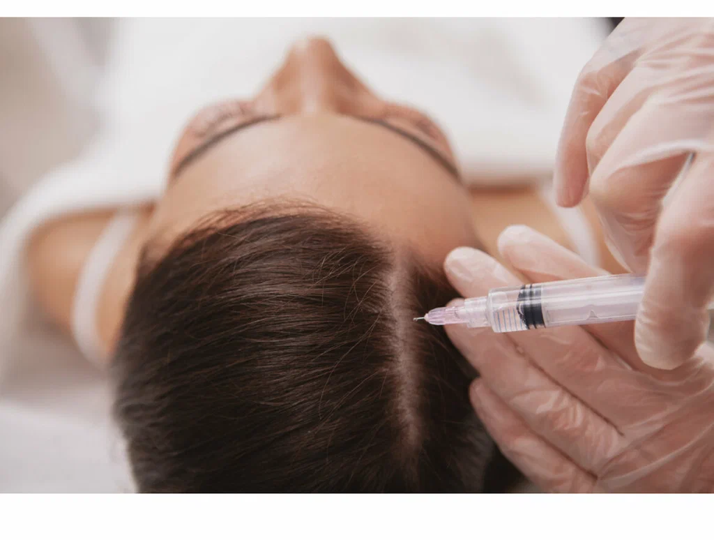 Инъекционная мезотерапия волос у женщины