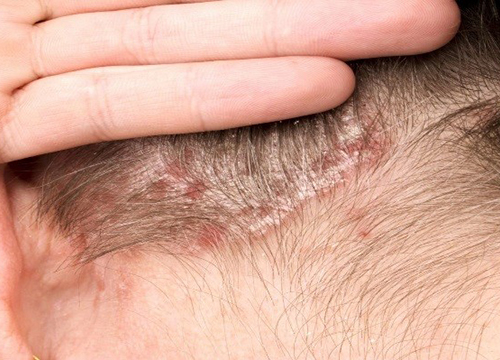 Воспаление кожи головы