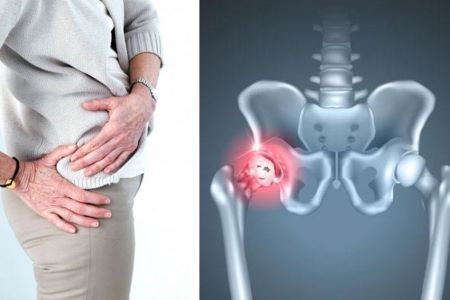 Лечение коксартроза 2 стадии с помощью SVF