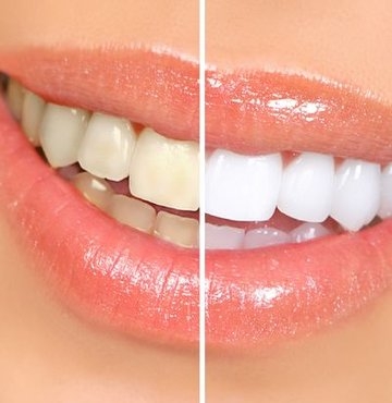 Профессиональное отбеливание зубов: цены в стоматологии, фото и методы — ROOTT