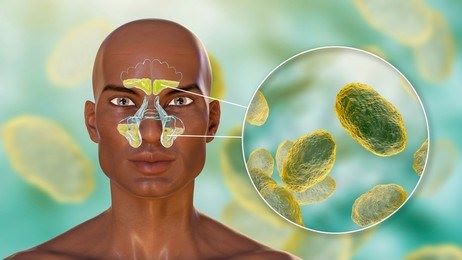 Хронический ринит с носительством условно-патогенной микрофлоры. Практика иммунотерапии. Клинический случай. Хронический ринит с носительством условно-патогенной микрофлоры. Практика иммунотерапии. Клинический случай.