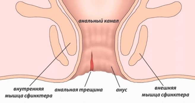 Анальная трещина: лечение и операция на заднем проходе по топ цене - Клиника Выходного Дня (Киев)