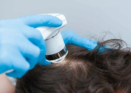 Андрогенетическая алопеция (АГА)