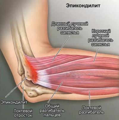 epikondilit.JPG