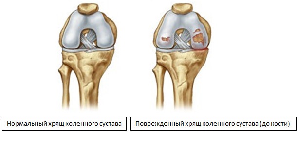 damaged_cartilage (1).jpg